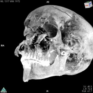 3D image of the pharaoh's skull.