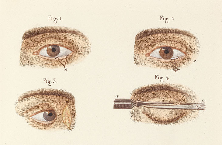 Précis iconographique de médecine opératoire et d’anatomie chirurgicale (1848), Claude Bernard and Charles Huette. Wellcome Library, London. ‘Skimmed-milk White’ is visible on the white of the human eyeball